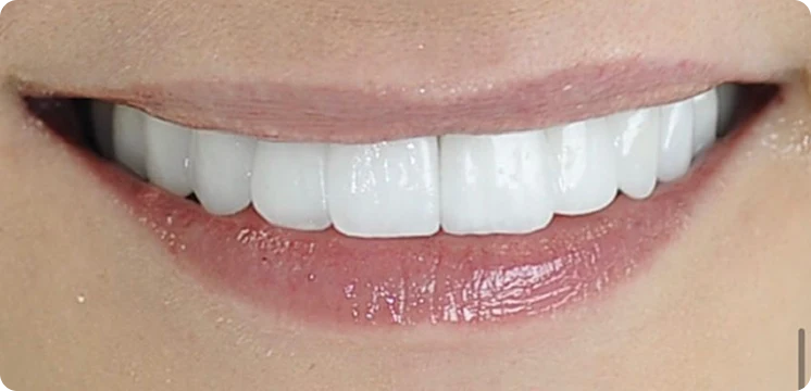 Korony i Mosty Cercon Dentsply Sirona